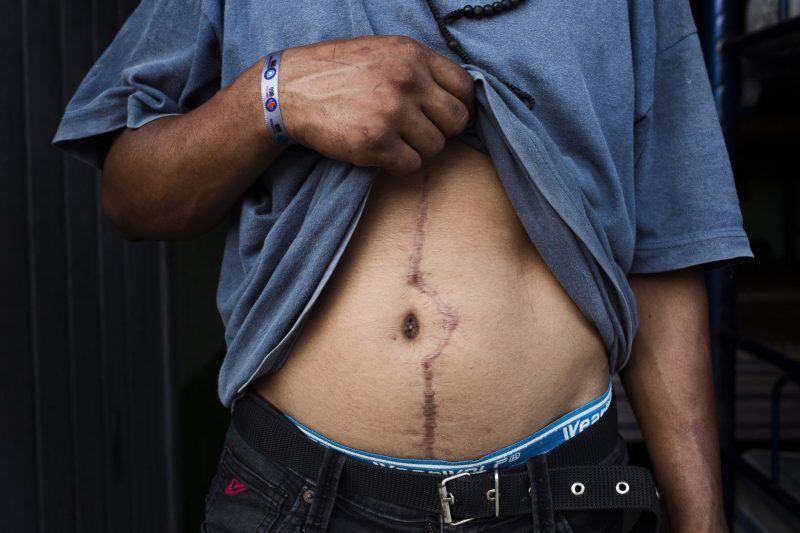  Willmer Villatoro's scar from a gunshot wound inflicted by gangs in El Salvador. Credit Katie Orlinsky for The New York Times 